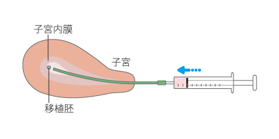 胚移植の図